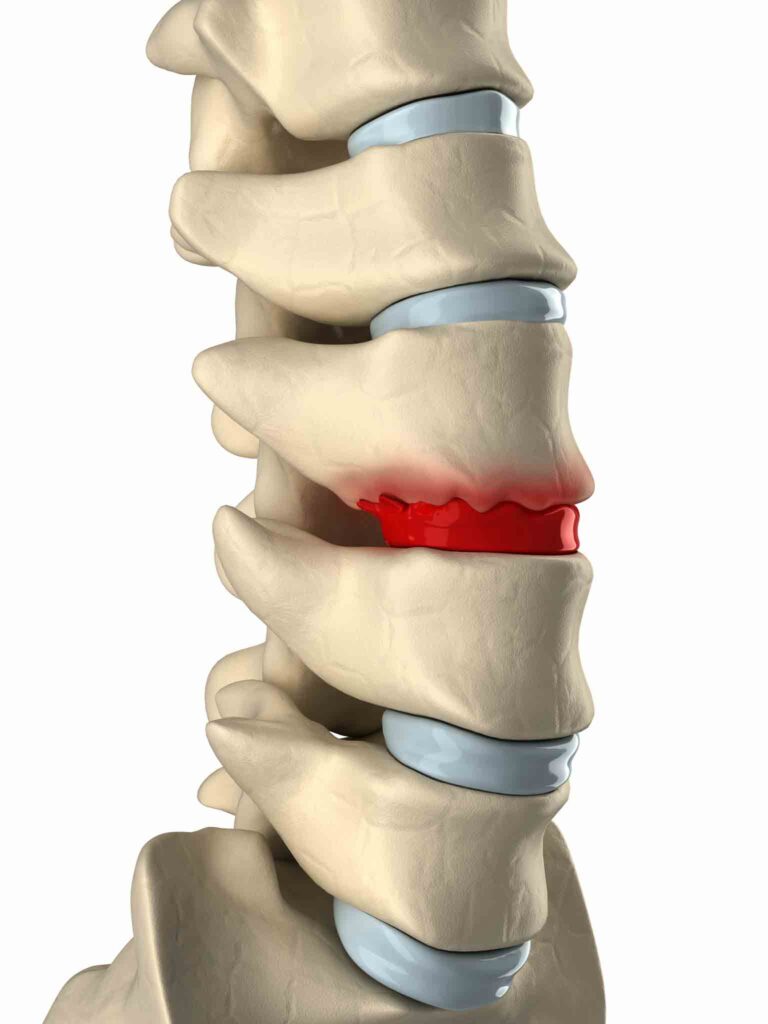 spinal cord injuries